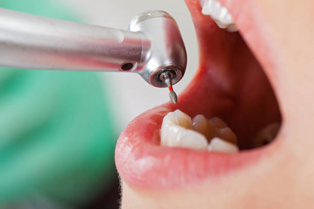 Best Lost Filling or Crown Replacement in Chigan Center, MI